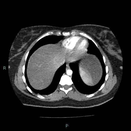 Acute bilateral pyelonephritis (Radiopaedia 37146-38881 Axial C+ arterial phase 10).jpg