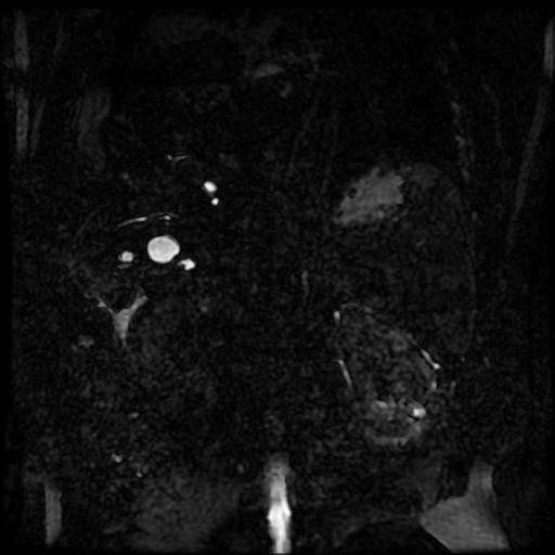 Acute cholecystitis and biliary hamartomas (Radiopaedia 86231-102240 E 15).jpg
