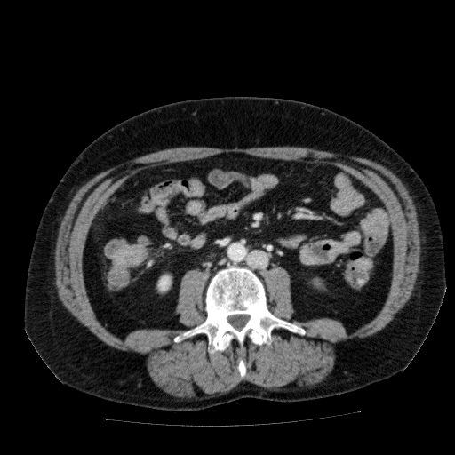 File:Acute cholecystitis and incidental left sided IVC (Radiopaedia 49352-54459 Axial C+ portal venous phase 84).jpg