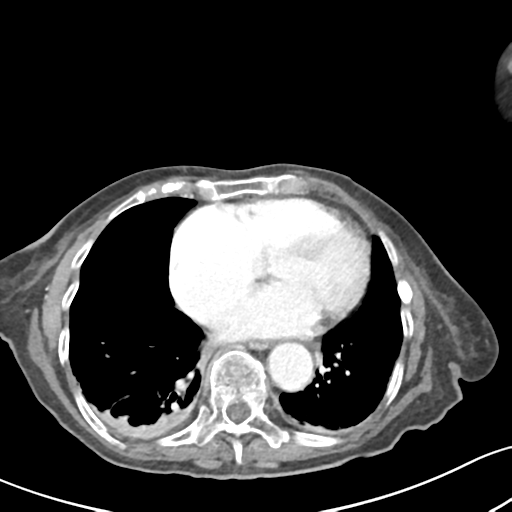 File:Acute cholecystitis with contained perforation (Radiopaedia 47328-51907 Axial C+ portal venous phase 1).png