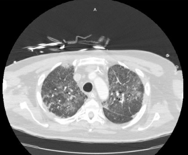 Acute cor pulmonale (ultrasound) (Radiopaedia 83508-98818 Axial lung window 23).jpg