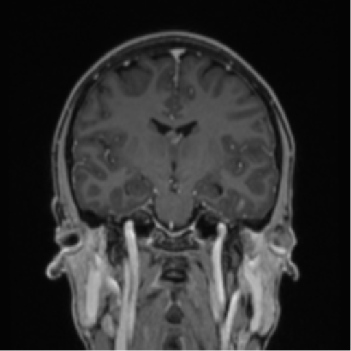 File:Acute disseminated encephalomyelitis (ADEM) (Radiopaedia 65319-74349 Coronal T1 C+ 25).png