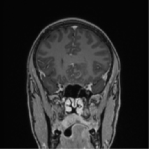 Acute disseminated encephalomyelitis (ADEM) (Radiopaedia 65319-74349 Coronal T1 C+ 41).png
