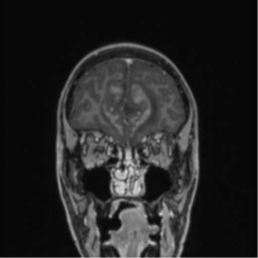 Acute disseminated encephalomyelitis (ADEM) (Radiopaedia 65319-74349 Coronal T1 C+ 53).png