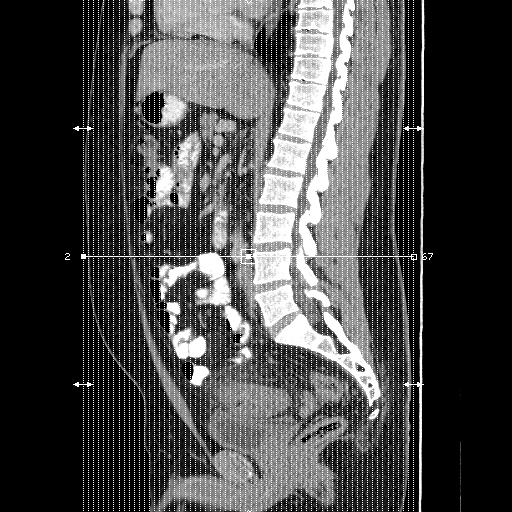 File:Acute diverticulitis with localized perforation (Radiopaedia 41296-44113 Coronal C+ portal venous phase 1).jpg