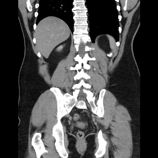 Acute diverticulitis with localized perforation (Radiopaedia 41296-44113 Coronal C+ portal venous phase 47).jpg