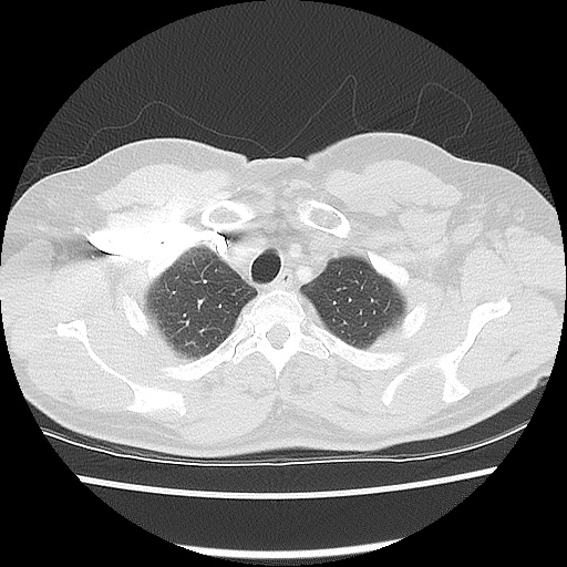 Acute epicardial fat necrosis (Radiopaedia 42327-45440 Axial lung window 13).jpg