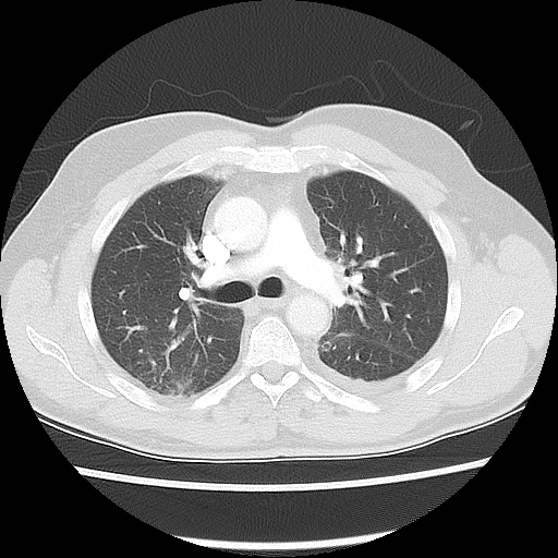 Acute epicardial fat necrosis (Radiopaedia 42327-45440 Axial lung window 25).jpg