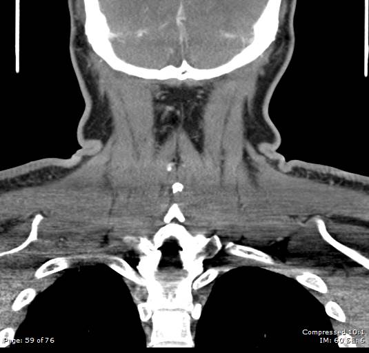 Acute epiglottitis (Radiopaedia 54375-60590 Coronal C+ arterial phase 59).jpg