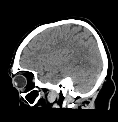 Acute internal carotid artery dissection (Radiopaedia 53541-59558 Sagittal non-contrast 18).jpg