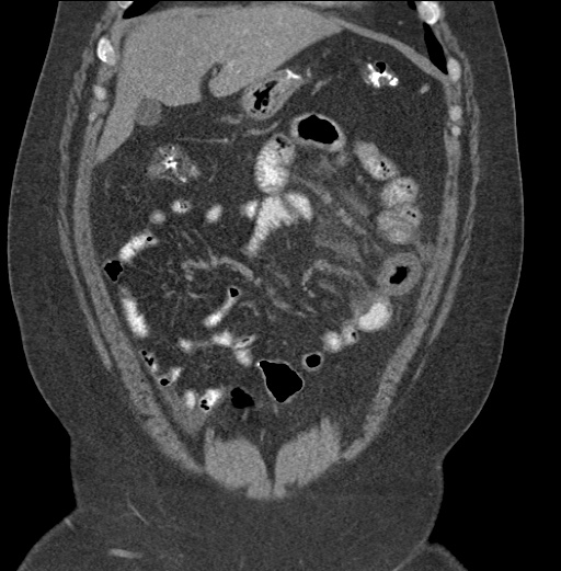 Acute mesenteric venous ischemia (Radiopaedia 46041-50383 Coronal C+ portal venous phase 27).jpg