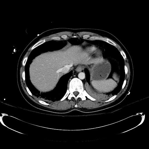 File:Acute myocardial infarction in CT (Radiopaedia 39947-42415 Axial C+ portal venous phase 18).jpg