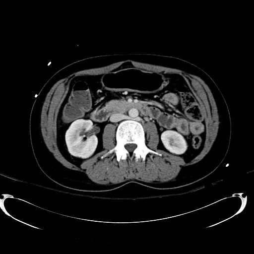 Acute myocardial infarction in CT (Radiopaedia 39947-42415 Axial C+ portal venous phase 60).jpg