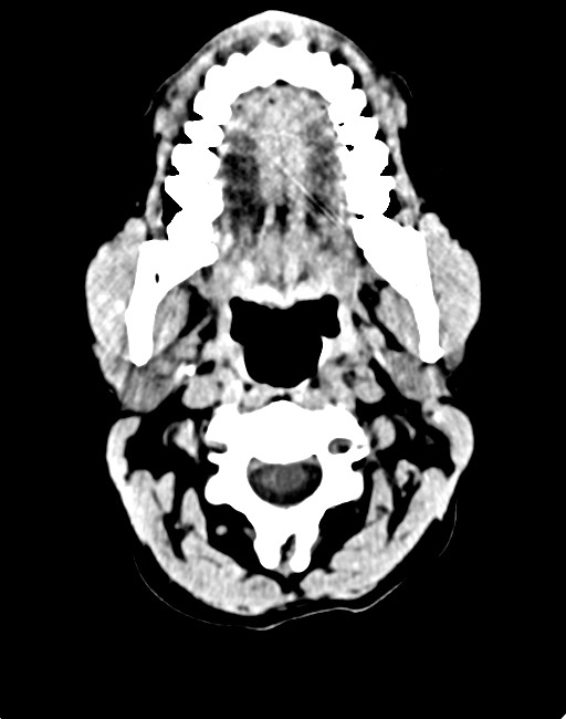 Acute on chronic subdural hematoma (Radiopaedia 74814-85823 Axial non-contrast 15).jpg