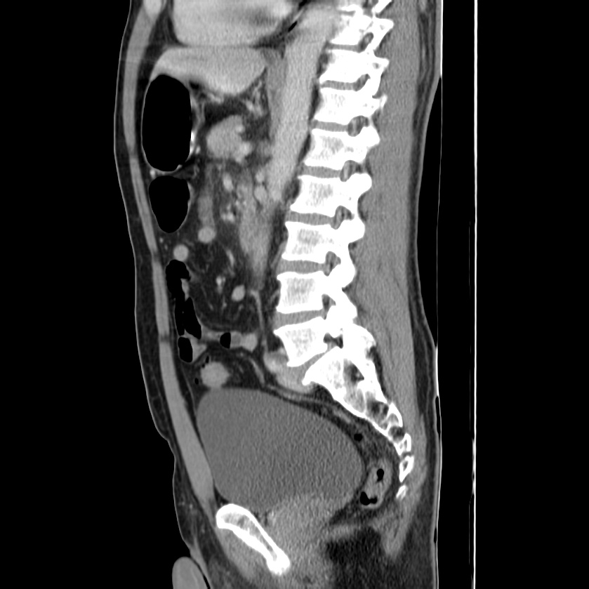 Acute pancreatitis (Radiopaedia 22572-22596 Sagittal C+ portal venous phase 31).jpg