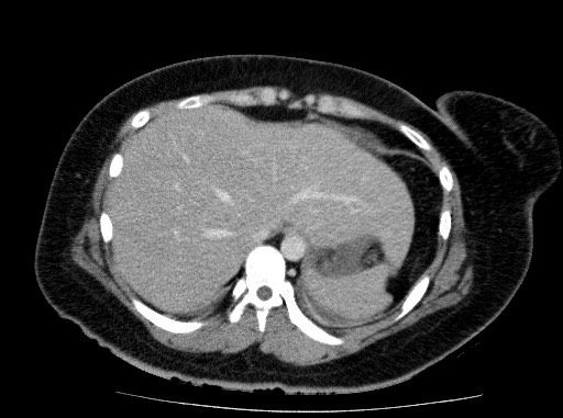 Acute pancreatitis (Radiopaedia 69236-79012 Axial C+ portal venous phase 15).jpg