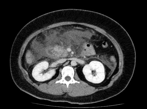 File:Acute pancreatitis (Radiopaedia 69236-79012 Axial C+ portal venous phase 38).jpg