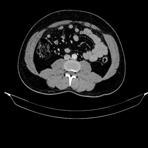 Acute pancreatitis (Radiopaedia 87428-103757 Axial C+ portal venous phase 58).jpg