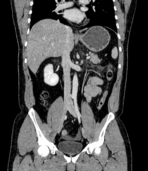 Acute pancreatitis (Radiopaedia 87428-103757 Coronal C+ portal venous phase 50).jpg