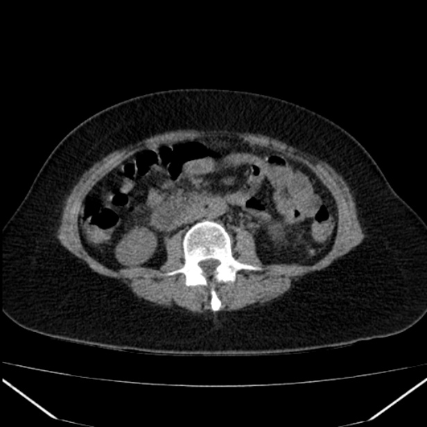 Acute pancreatitis - Balthazar C (Radiopaedia 26569-26714 Axial non-contrast 50).jpg