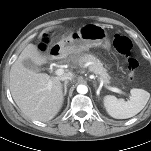 File:Acute pancreatitis and walled-off necrosis (Radiopaedia 29888-30403 Axial C+ portal venous phase 10).jpg
