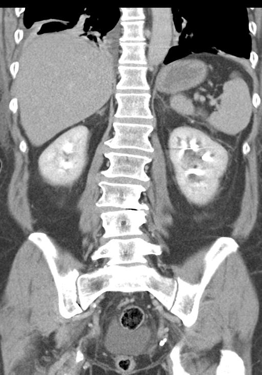 Acute pancreatitis and walled-off necrosis (Radiopaedia 29888-30403 E 40).jpg