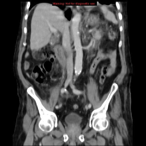 Acute pancreatitis with incidental pancreatic lipoma (Radiopaedia 10190-10730 Coronal C+ portal venous phase 38).jpg