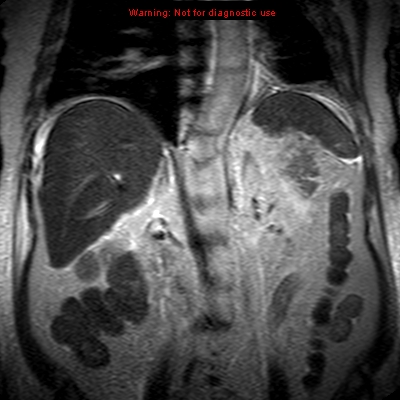 File:Acute pancreatitis with incidental pancreatic lipoma (Radiopaedia 10190-10732 Coronal T2 20).jpg
