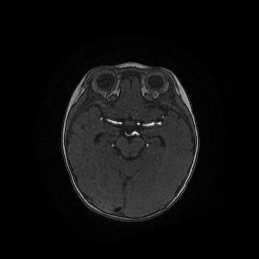 Acute phase of hemiconvulsion-hemiplegia epilepsy syndrome (Radiopaedia 29309-29745 Axial TOF angiography 79).jpg