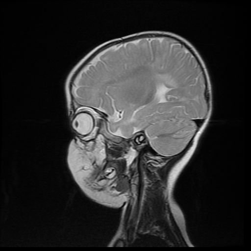 File:Acute phase of hemiconvulsion-hemiplegia epilepsy syndrome (Radiopaedia 29309-29745 Sagittal T2 7).jpg