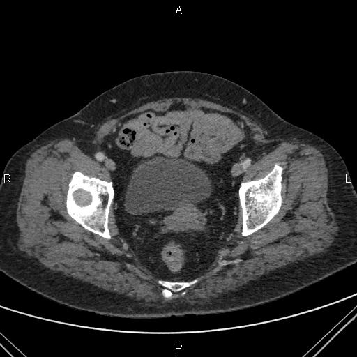 File:Acute renal artery occlusion (Radiopaedia 86586-102682 Axial C+ portal venous phase 88).jpg