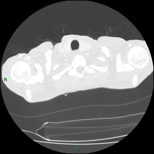 File:Acute right lung abscess (Radiopaedia 34806-36258 Axial lung window 3).jpg