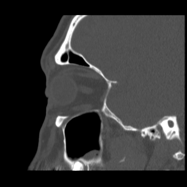 Acute sinusitis (Radiopaedia 23161-23215 Sagittal bone window 19).jpg