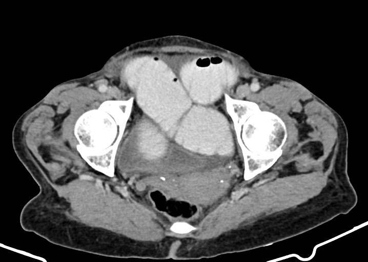 Acute small bowel (ileal) volvulus (Radiopaedia 71740-82139 Axial C+ portal venous phase 181).jpg