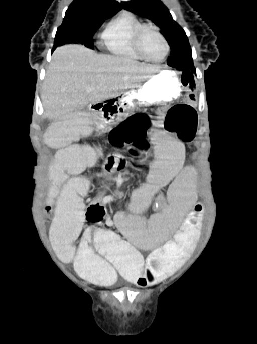 Acute small bowel (ileal) volvulus (Radiopaedia 71740-82139 Coronal C+ portal venous phase 29).jpg