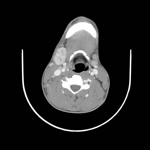 File:Acute submandibular sialadenitis secondary to ductal stone (Radiopaedia 27999-28267 Axial C+ delayed 29).jpg