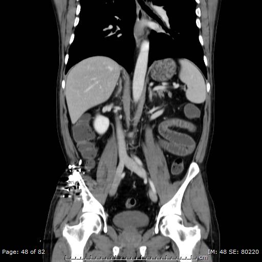 Acute superior mesenteric artery occlusion (Radiopaedia 43636-47060 Coronal C+ portal venous phase 33).jpg