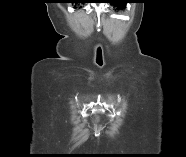 Acute superior mesenteric artery occlusion (Radiopaedia 43926-47418 Coronal C+ portal venous phase 48).png
