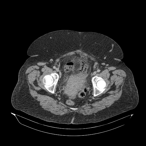 Acute superior mesenteric artery occlusion (Radiopaedia 51288-56960 Axial C+ portal venous phase 93).jpg