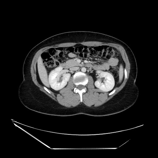Acute uncomplicated appendicitis (Radiopaedia 73704-84499 Axial C+ portal venous phase 61).jpg