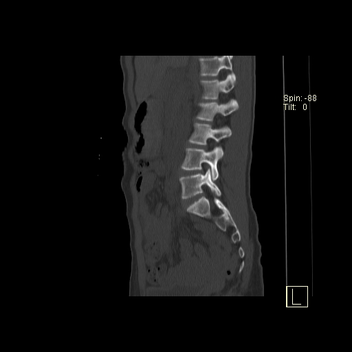 File:Acute vertebral compression fracture (Radiopaedia 63832-72559 Sagittal bone window 19).jpg