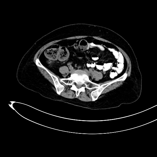 Adenocarcinoma colon with intussusception (Radiopaedia 86006-101922 Axial non-contrast 39).jpg