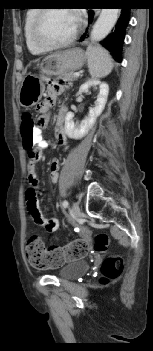 Adenocarcinoma of cecum (Radiopaedia 59222-66549 Sagittal C+ portal venous phase 29).jpg