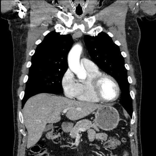 Adenocarcinoma of the lung (Radiopaedia 59871-67325 Coronal C+ arterial phase 20).jpg