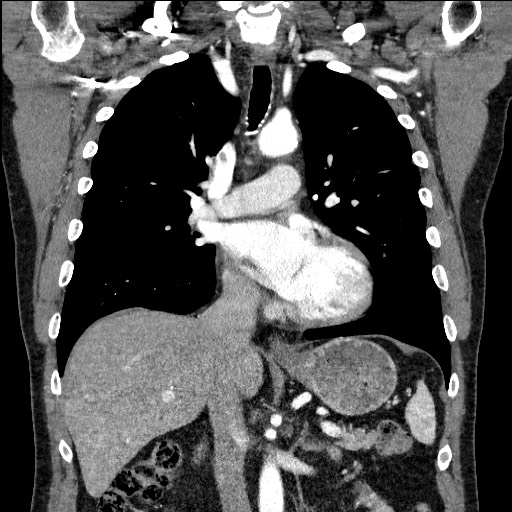 Adenocarcinoma of the lung (Radiopaedia 59871-67325 Coronal C+ arterial phase 33).jpg