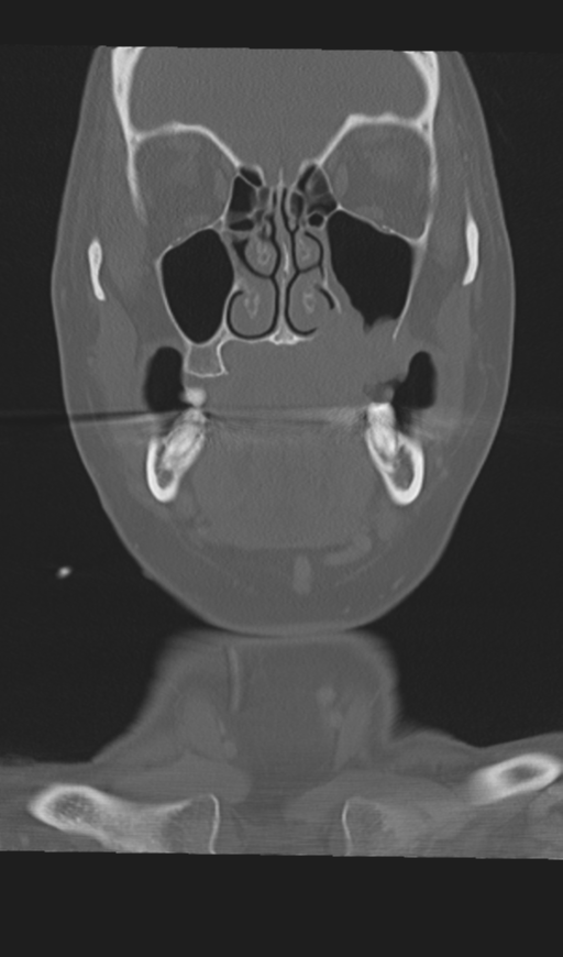 Adenoid cystic tumor of palate (Radiopaedia 46980-51518 Coronal bone window 23).png