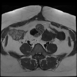 File:Adenomyosis within a didelphys uterus (Radiopaedia 70175-80215 Axial T1 13).jpg