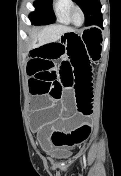 Adhesional small bowel obstruction (Radiopaedia 52107-57980 Coronal C+ portal venous phase 16).jpg
