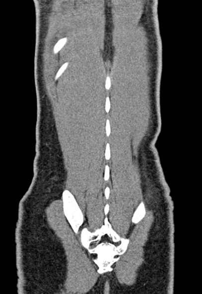 File:Adhesional small bowel obstruction (Radiopaedia 52107-57980 Coronal C+ portal venous phase 75).jpg