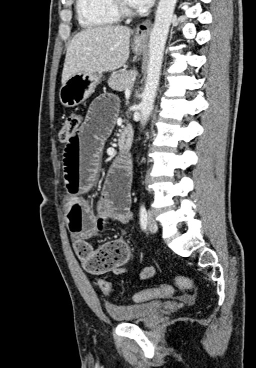 Adhesional small bowel obstruction (Radiopaedia 58900-66131 Sagittal C+ portal venous phase 141).jpg